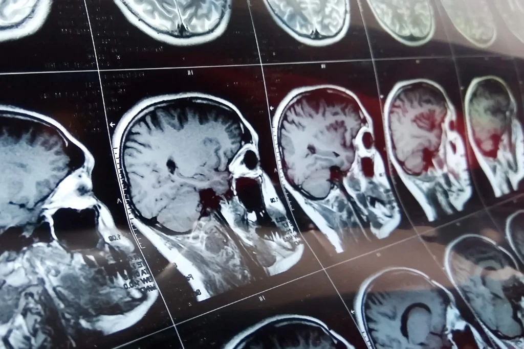 Close up shot of MRIs.
