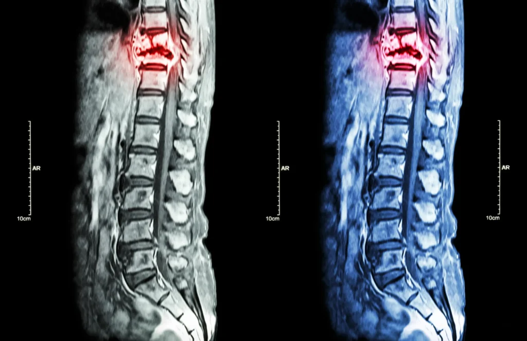 An x-ray of a spine.